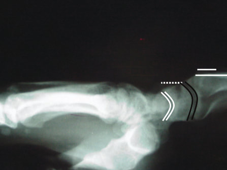 X-ray of a wrist of someone with carpel tunnel